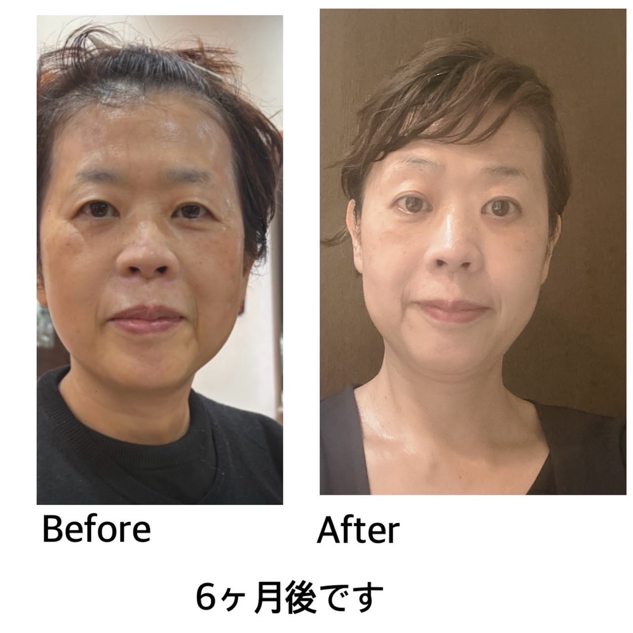 美容ジェル ご愛用者様事例2